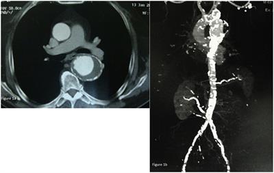 Thoracic Aorta Aneurysm Repair in a Patient with a Solitary Kidney: Hybrid Surgery as a Bailout Procedure